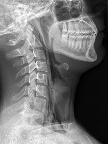 Lateral Soft Tissue Neck for Foreign Body - wikiRadiography