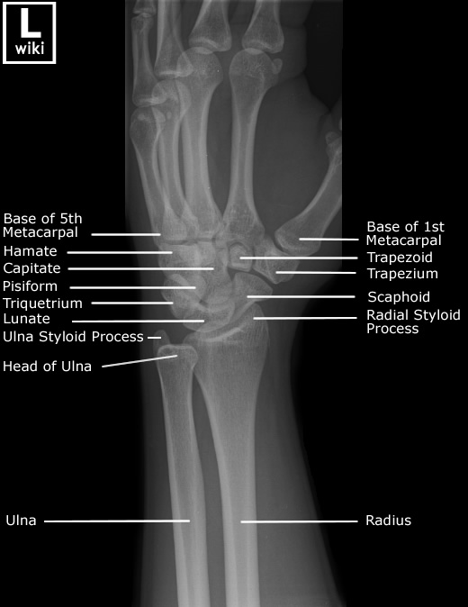 Radiographic Anatomy - Wrist Oblique