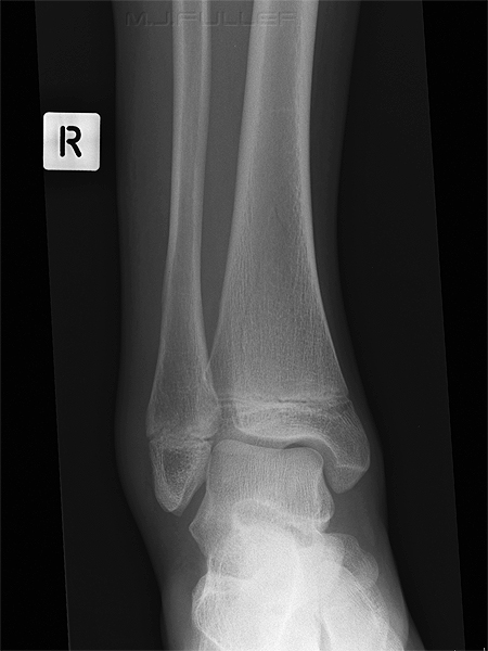 ankle trauma case 1 ap