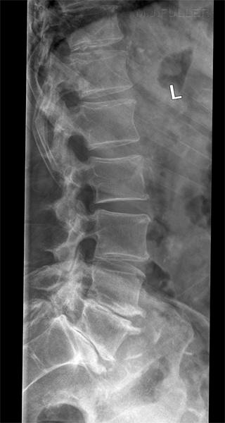 lateral lumbar spine