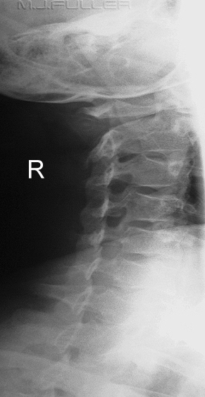 Trauma Obliques of the Cervical Spine - wikiRadiography