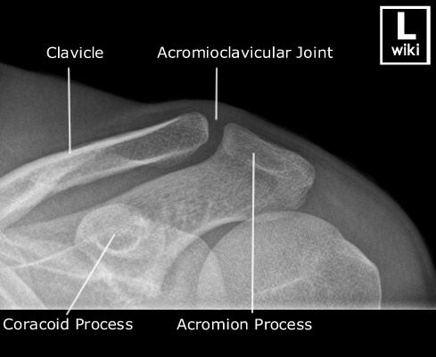 Adult - Acromioclavicular Joint - AP