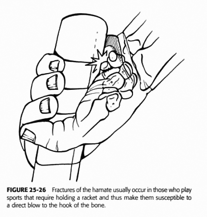 hamate fracture mechanism of injury