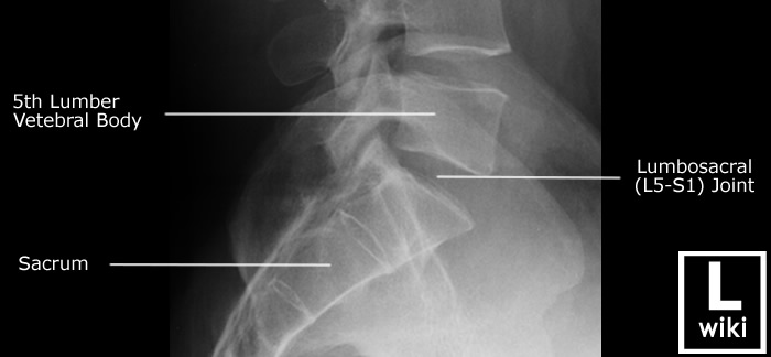 Radiographic Anatomy - Lumber Spine L5S1