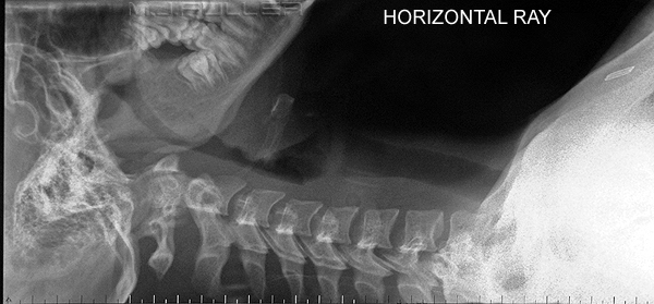 The Trauma Lateral Cervical Spine - wikiRadiography