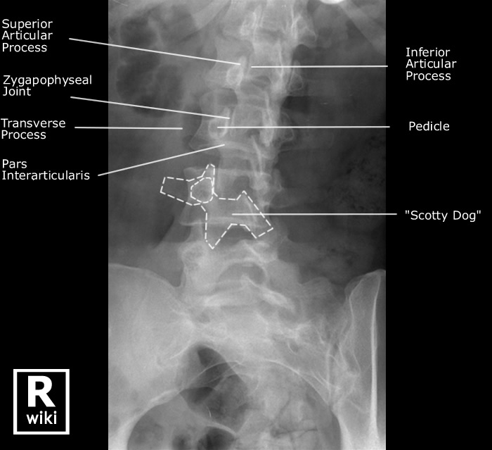 Radiographic Anatomy - Lumber Spine Oblique