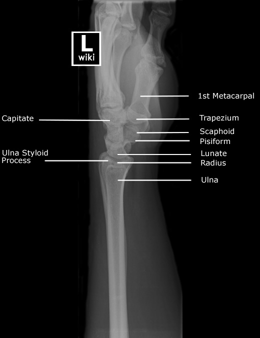 Radiographic Anatomy - Wrist Lateral
