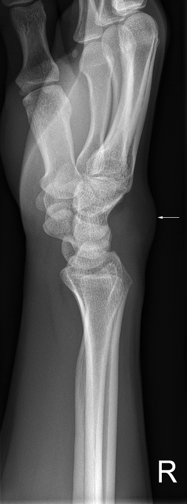 Radiography of Subtle Wrist Fractures - wikiRadiography