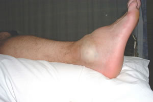 Swollen Ankle showing the 5 characteristic signs