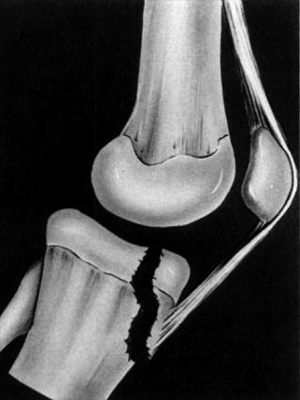 tibial tuberosity fracture type II