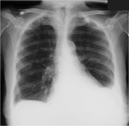 false pneumothorax