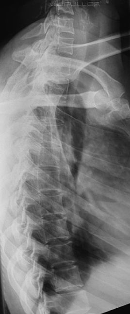 Lateral Thoracic Spine Special Technique - wikiRadiography