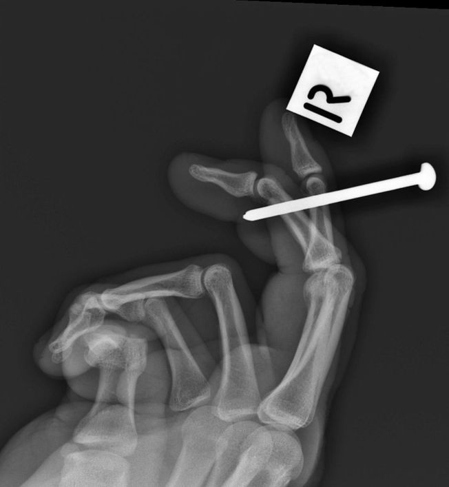 Imaging Nail Gun Injuries - wikiRadiography