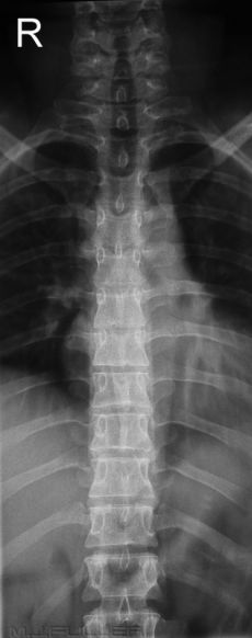 Aluminium Filter Techniques in Radiography - wikiRadiography