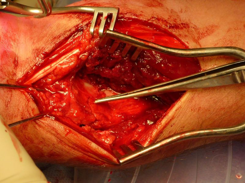 Volar Plate Surgery for Distal Radius Fracture