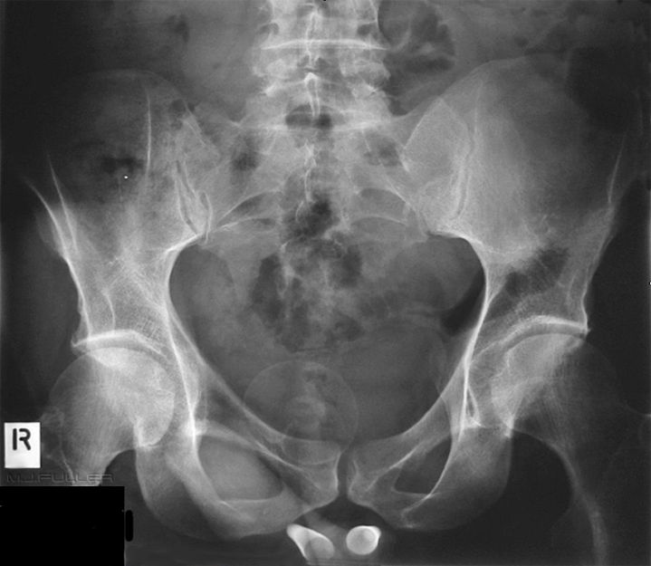 Pelvis Artifacts, variants and calcifications - wikiRadiography