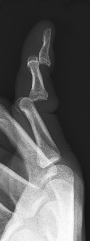 PIP and DIP dislocations