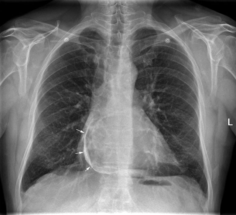 pericardial calcification