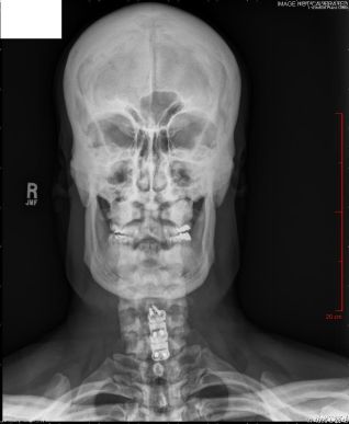 Osteopetrosis skull
