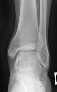NORMAL ANKLE SOFT TISSUES