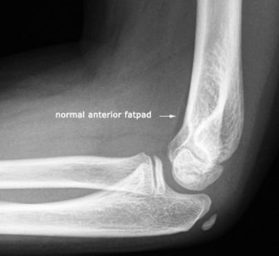 normal anterior elbow fatpad