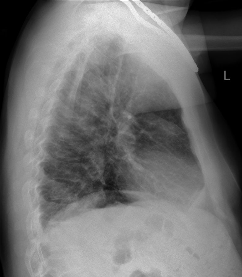 lateral chest
