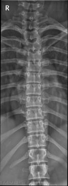 AP Thoracic Spine Breathing Technique - wikiRadiography