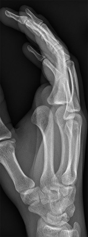 MCP joint dislocation
