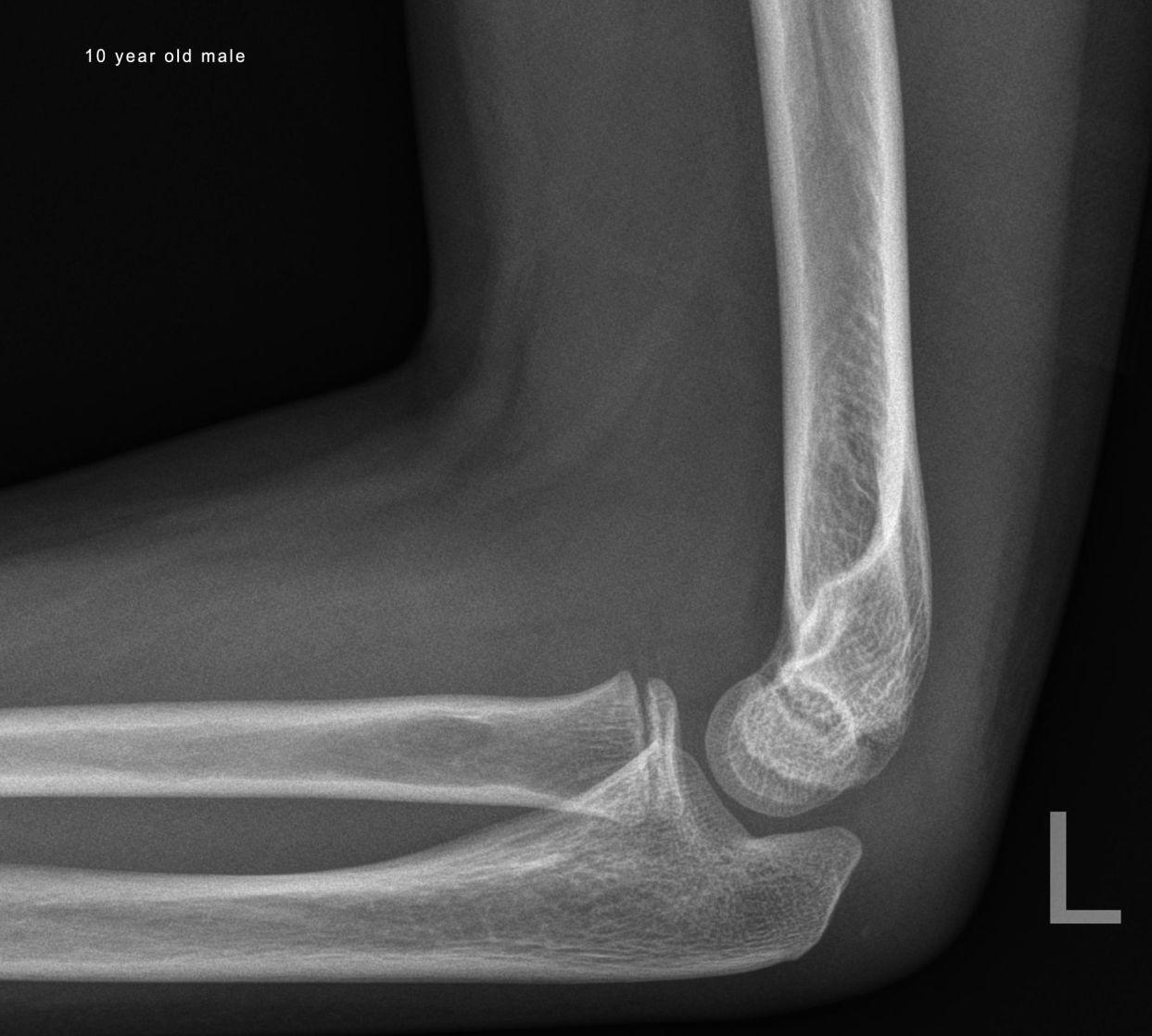 lateral elbow normal male 10 yrs