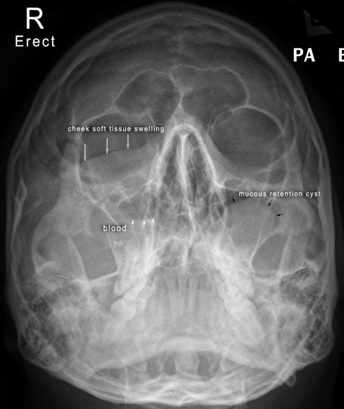 Facial Bone Radiography - wikiRadiography