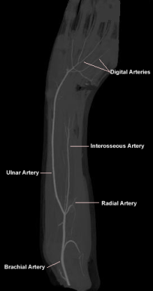 CT Case 2 - Hypoplastic Radial Artery - wikiRadiography