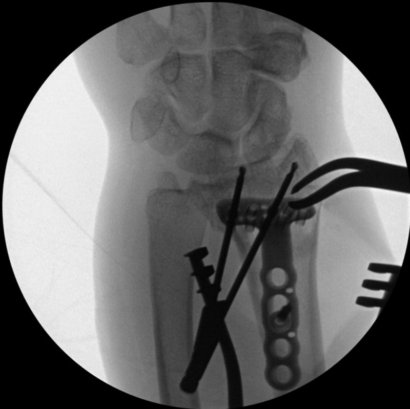 Operative Imaging for Distal Radius Fracture Volar Plate Surgery - wikiRadiography