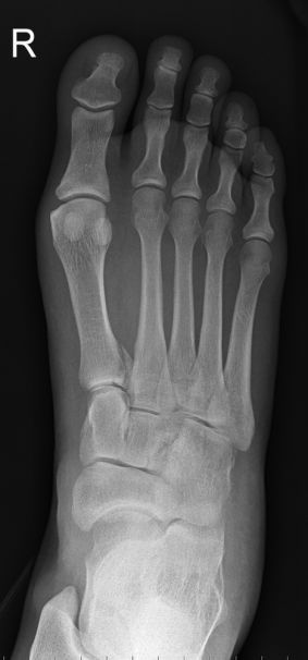 DP foot