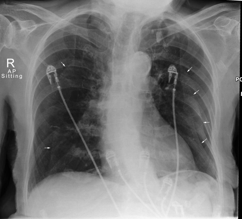 Pneumothorax Cases - wikiRadiography