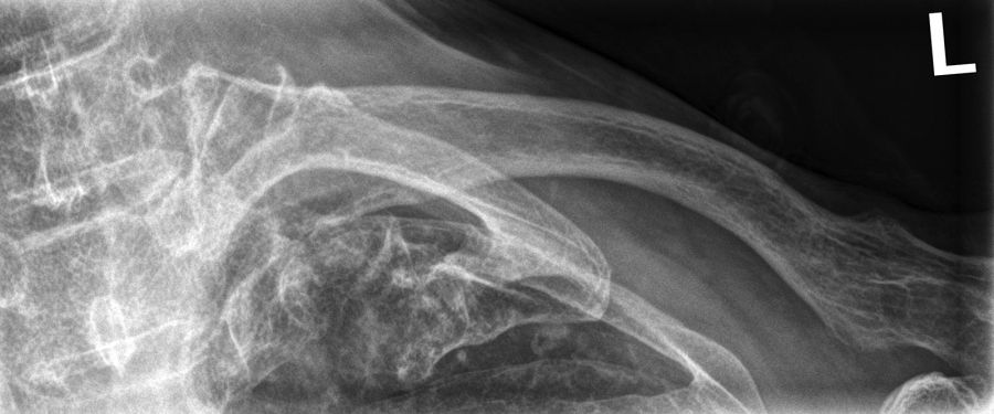 clavicle radiography