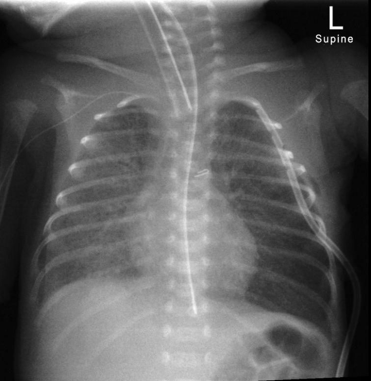 Pneumothorax Cases - wikiRadiography