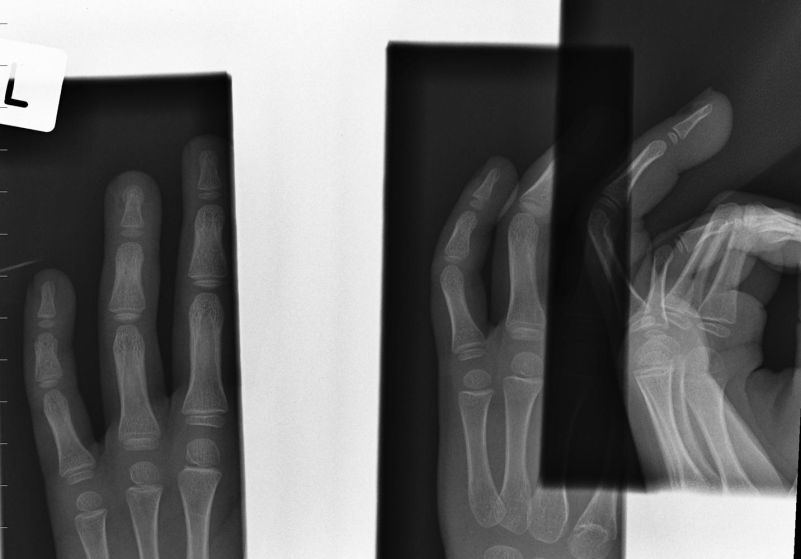 finger radiography