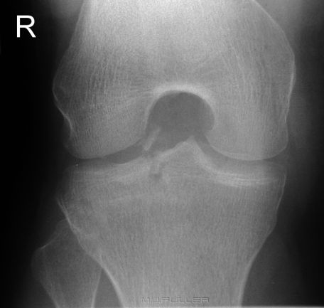 Supine Intercondylar Knee Radiography - wikiRadiography