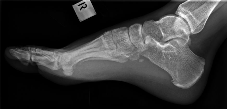 Calcaneal Fractures - wikiRadiography