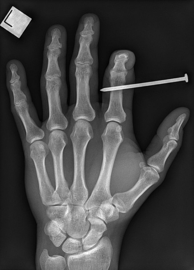 nailgun finger