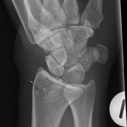 Radiography of Subtle Wrist Fractures - wikiRadiography