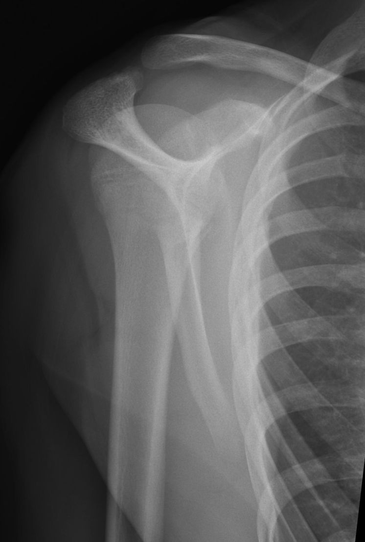 lateral scapula 15 year old male