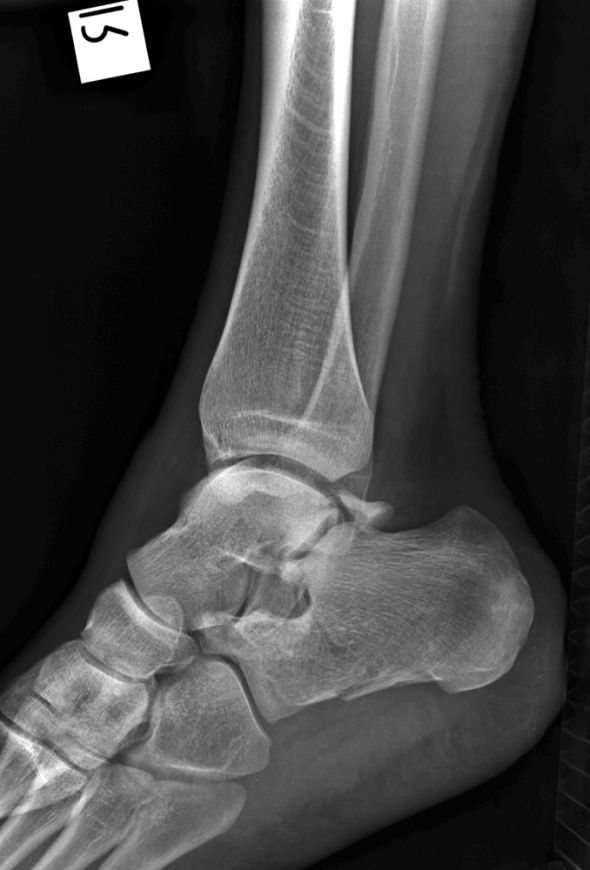 lateral ankle