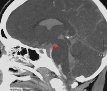 CT Case 3 - Subarachnoid Haemorrhage with Cerebrovascular Spasm - wikiRadiography