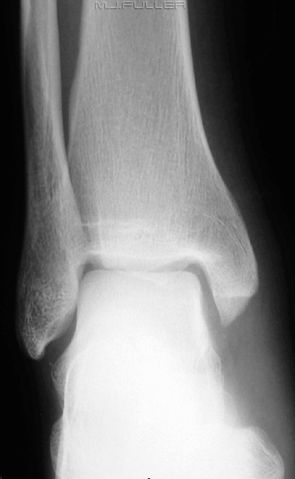 The Lateral Ankle Trap - wikiRadiography