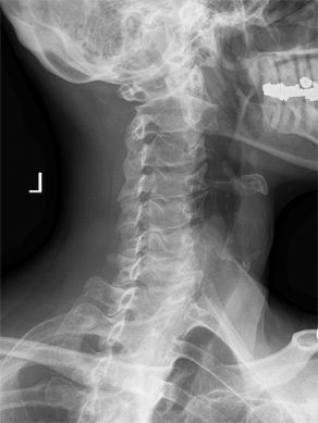 oblique cervical spine positioning
