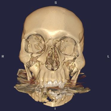 CT Case 4 - Le Fort Fractures - wikiRadiography