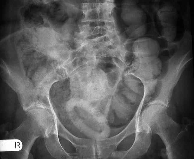 Pelvis Anatomy, Artifacts, Variants and Calcifications - wikiRadiography
