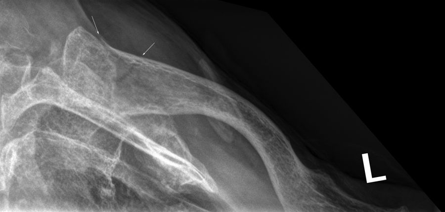 clavicle radiography
