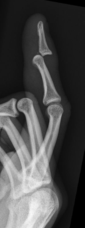 finger phalanx dislocation
